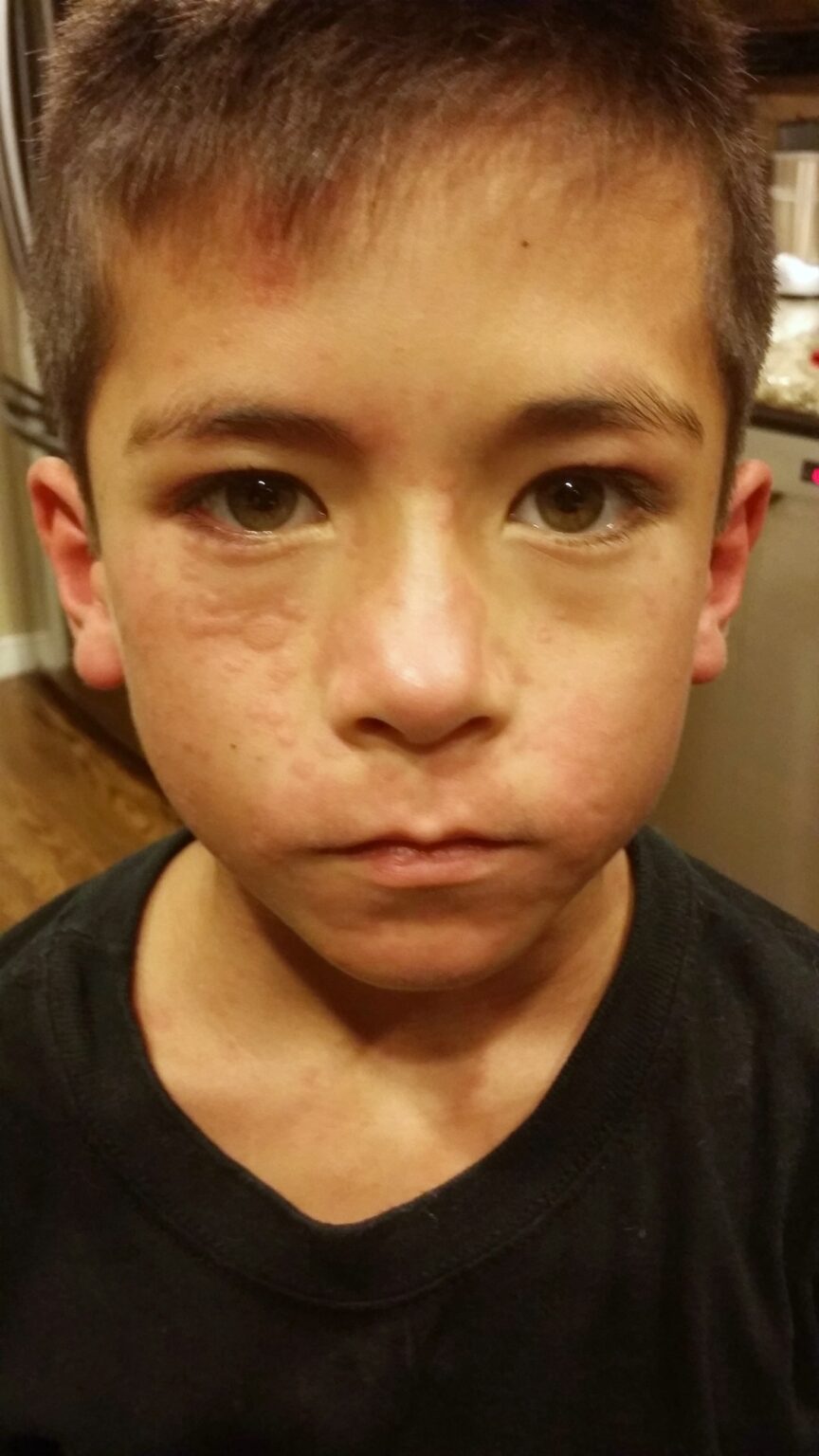 How to Tips for Living with an Egg Allergy Allergylicious